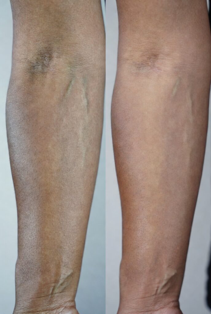 Two Types of "Faded" — And Why the Difference Matters
Tattoo Color Fading Fix